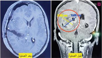 مستشفى الدكتور سليمان الحبيب بالقصيم ينقذ حياة فتاة كويتية