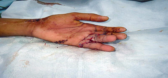 إعادة «أصابع» يد متهتكة لمريض بمستشفى الملك فهد بجازان 