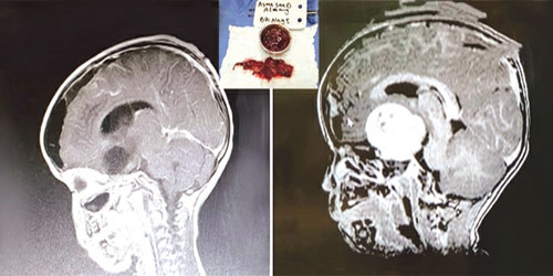 جراحة دقيقة بمستشفى د. سليمان الحبيب بالقصيم تنقذ طفلة من مضاعفات ورم متغلغل إلى قاع الدماغ 