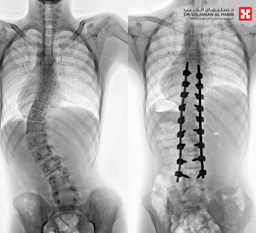 مستشفى الدكتور سليمان الحبيب بالقصيم ينهي معاناة شاب مع انحراف متطور بالعمود الفقري 