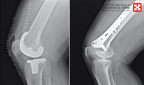 مستشفى الدكتور سليمان الحبيب بالصحافة يجري عملية نوعية لاستبدال مفصل الركبة لـ«ثمانيني» 